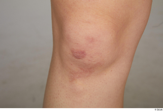 Aera knee scab 0001.jpg